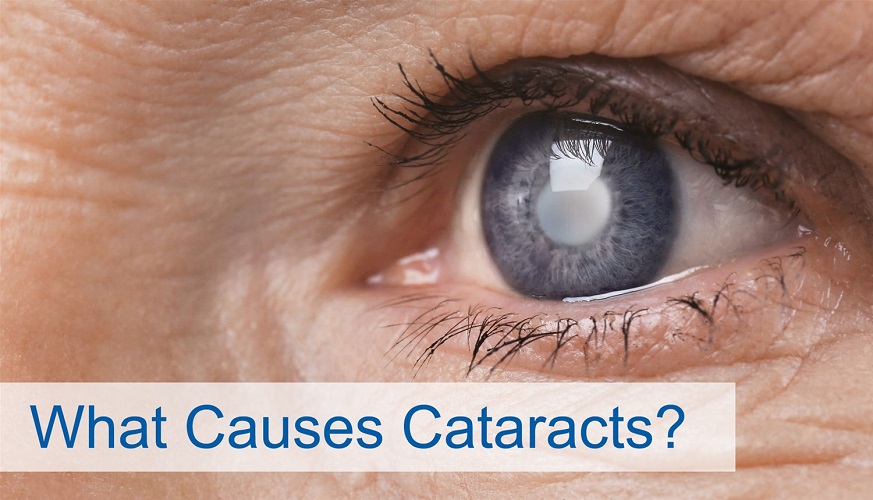 Your Diet and How It Affects Cataracts