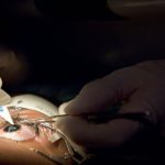 5 Reasons That You Should Not Retain Fears Of Laser Eye Surgery
